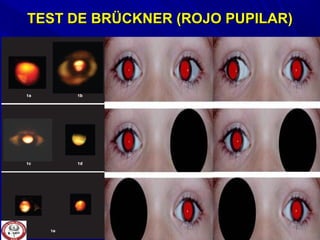 TEST DE BRÜCKNER (ROJO PUPILAR)TEST DE BRÜCKNER (ROJO PUPILAR)
 