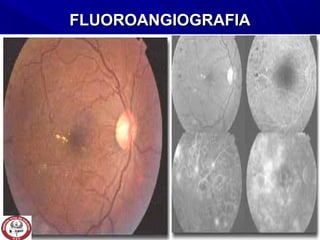 FLUOROANGIOGRAFIAFLUOROANGIOGRAFIA
 