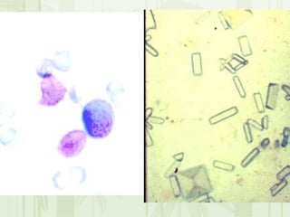 Cặn lắng nước tiểu