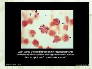 Cặn lắng nước tiểu