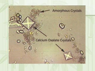 Cặn lắng nước tiểu