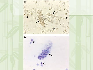 Cặn lắng nước tiểu