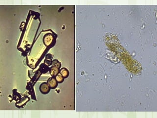 Cặn lắng nước tiểu