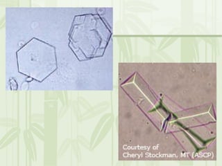 Cặn lắng nước tiểu