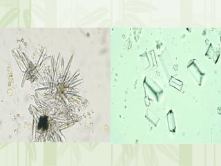 Cặn lắng nước tiểu