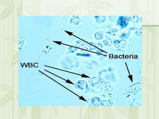 Cặn lắng nước tiểu