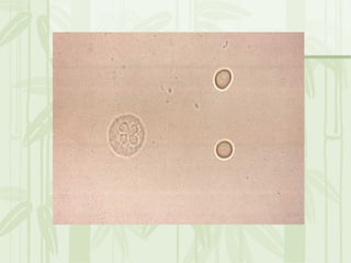 Cặn lắng nước tiểu