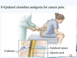 8-Epidural clonidine analgesia for cancer pain.
11
 