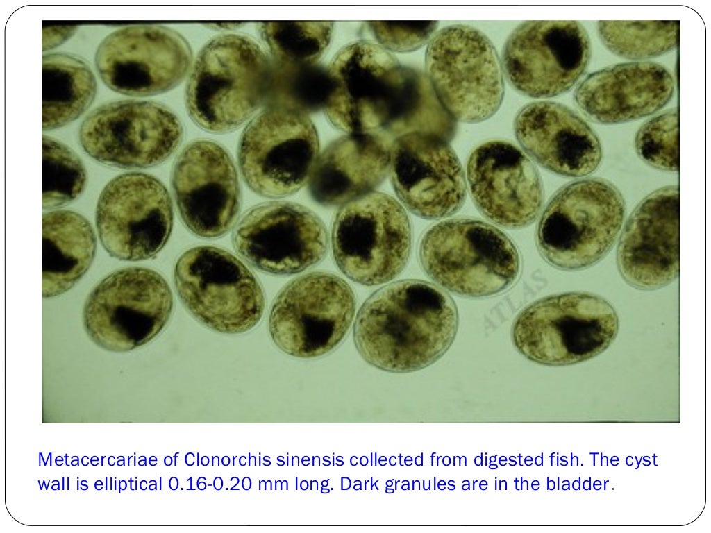 Clonorchiasis sinensis