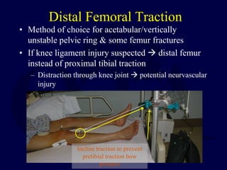 Distal Traction Rotation Closed_Reduction,_Traction_and_Casting_Techniques.pdf