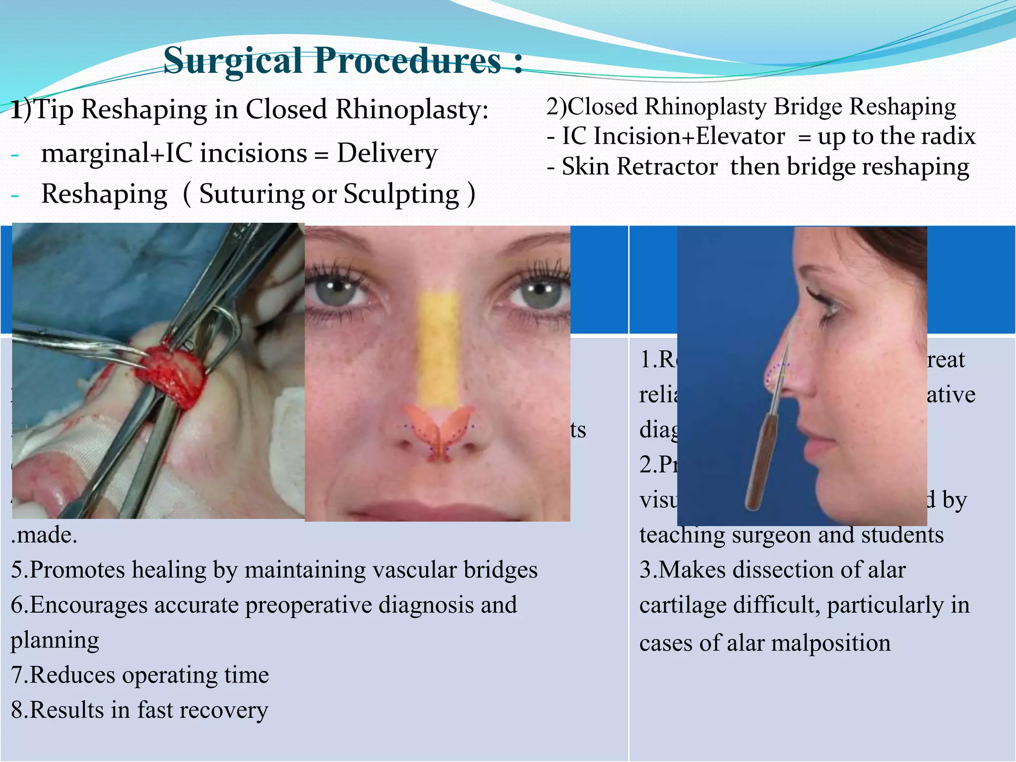 Closed rhinoplasty | PPT