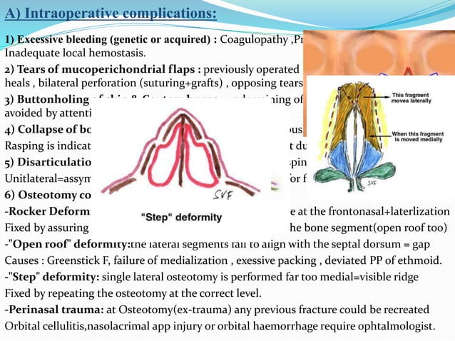 Closed rhinoplasty | PPT