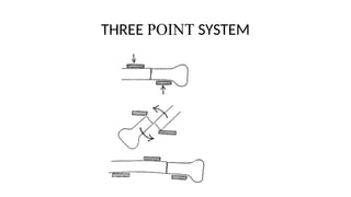 Three Point Closure Comprehensive Overview of Closed Treatment of Fractures in Orthopaedic ...