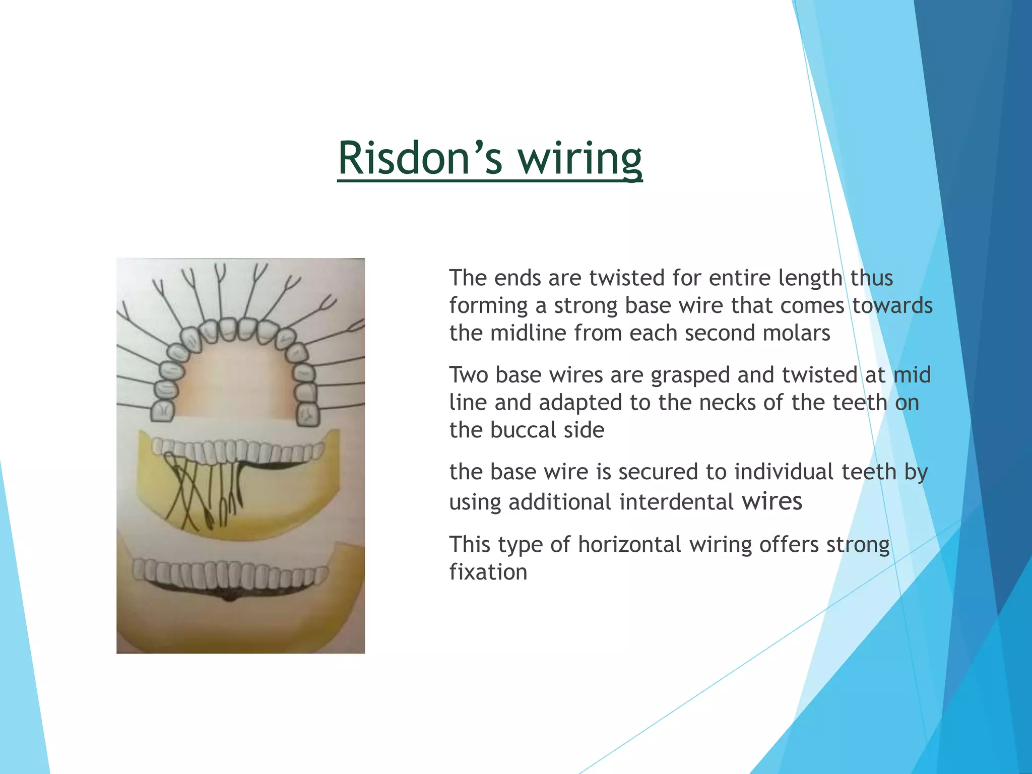 Closed Reduction in Mandibular Fractures | PPTX