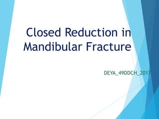 Closed Reduction in
Mandibular Fracture
DEYA_49DDCH_2017
 