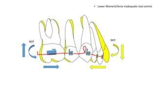 • Lower Moment/force inadequate root control
M/F
M/F
 