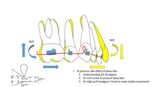 • To prevent side-effect of deep bite
1. Gable bending 20-30 degree
2. Or mini screw to prevent deep bite
3. Or High pull headgear J-hook to make bodily movement
M/F
M/F
 