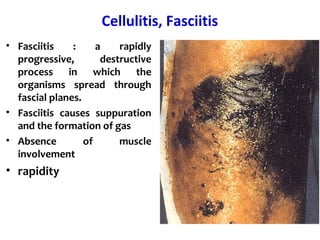 Progressive Cellulitis Clostridial toxins: Clostridium perfringens and Clostridium difficile | PPT