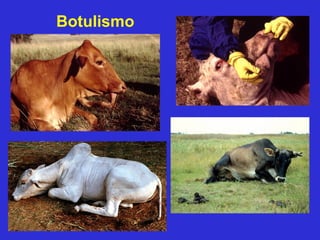 Botulismo
 