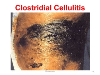 Clostridial Cellulitis




         Dr.T.V.Rao MD   26
 