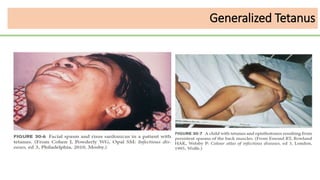 Generalized Tetanus
 