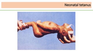 Neonatal tetanus
 