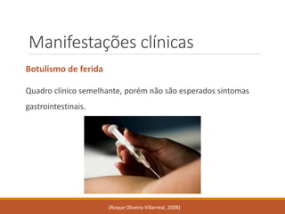Manifestações clínicas 
Botulismo de ferida 
Quadro clínico semelhante, porém não são esperados sintomas gastrointestinais. 
(Roque Oliveira Villarreal, 2008)  