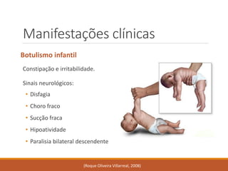 Manifestações clínicas 
Botulismo infantil 
Constipação e irritabilidade. 
Sinais neurológicos: 
•Disfagia 
•Choro fraco 
•Sucção fraca 
•Hipoatividade 
•Paralisia bilateral descendente 
(Roque Oliveira Villarreal, 2008)  