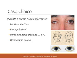 Caso Clínico 
Durante o exame físico observou-se: 
•Midríase simétrica 
•Ptose palpebral 
•Paresia de nervo craniano V1e V2 
•Hemograma normal 
(Cardoso T., Costa M., Almeida H., Guimarães M., 2004)  