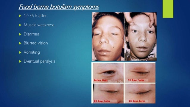 Clostridium Botulinum Disease Clostridium Botulinum Disease