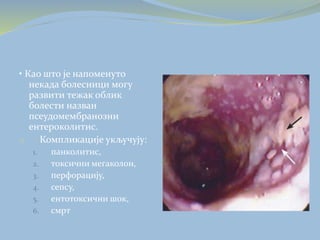 • Као што је напоменуто
некада болесници могу
развити тежак облик
болести назван
псеудомембранозни
ентероколитис.
o Компликације укључују:
1. панколитис,
2. токсични мегаколон,
3. перфорацију,
4. сепсу,
5. ентотоксични шок,
6. смрт
 