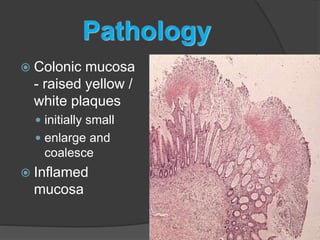 Pathology 
 Colonic mucosa 
- raised yellow / 
white plaques 
 initially small 
 enlarge and 
coalesce 
 Inflamed 
mucosa 
 