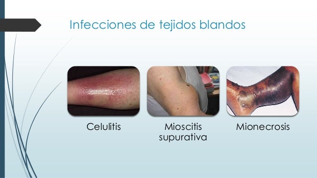 Clostridium perfringens