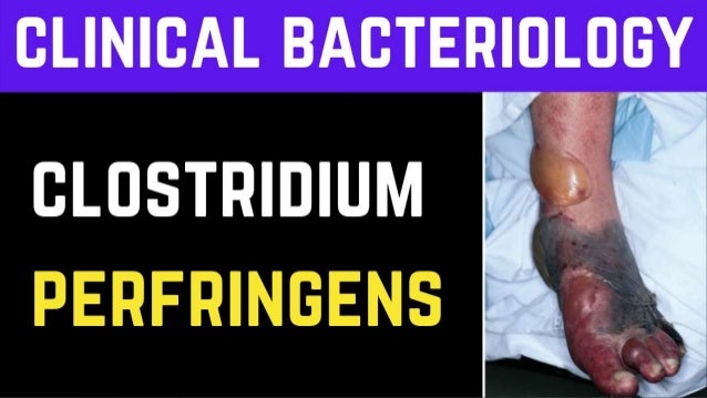 Clostridium Perfringens Bacteria | Clinical Bacteriology | Microbiology ...