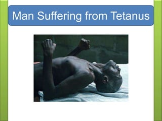 Man Suffering from Tetanus
 