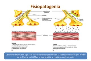 La toxina tetánica se liga a las interneuronas que inhiben la liberación de Ach por medio
de la Glicina y el GABA, lo que impide la relajación del músculo
Fisiopatogenia
 
