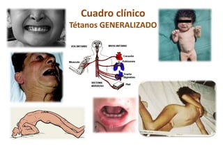 Cuadro clínico
Tétanos GENERALIZADO
 