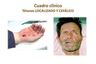 Cuadro clínico
Tétanos LOCALIZADO Y CEFÁLICO
 