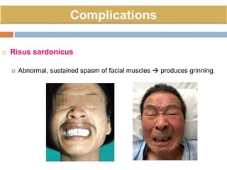  Risus sardonicus
 Abnormal, sustained spasm of facial muscles  produces grinning.
 