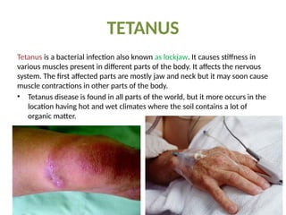 CLOSTRIDIUM TETANI Microbial disease.pptx