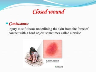 Closed wound
Contusions :
injury to soft tissue underlining the skin from the force of
contact with a hard object sometimes called a bruise
 