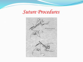 Suture Procedures
 