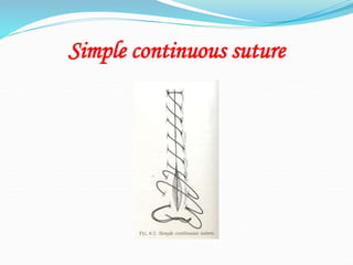 Simple continuous suture
 
