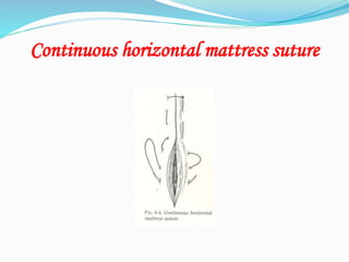 Continuous horizontal mattress suture
 