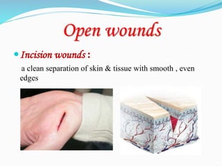 Open wounds
Incision wounds :
a clean separation of skin & tissue with smooth , even
edges
 