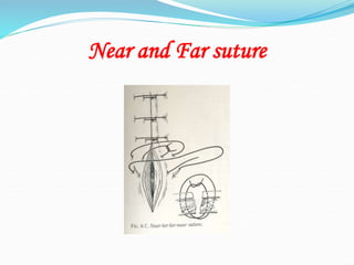 Near and Far suture
 