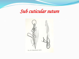 Sub cuticular suture
 