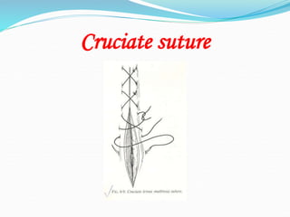 Cruciate suture
 
