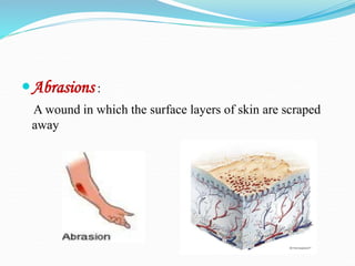 Abrasions :
A wound in which the surface layers of skin are scraped
away
 