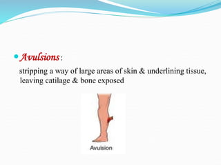 Avulsions :
stripping a way of large areas of skin & underlining tissue,
leaving catilage & bone exposed
 